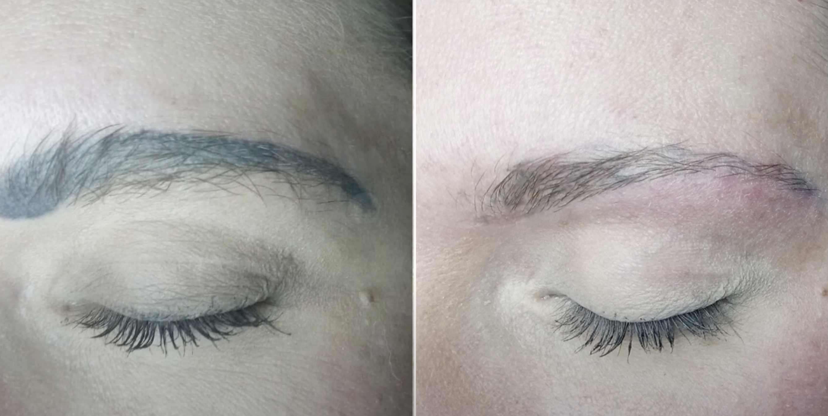 Permanent Make-up Entfernung